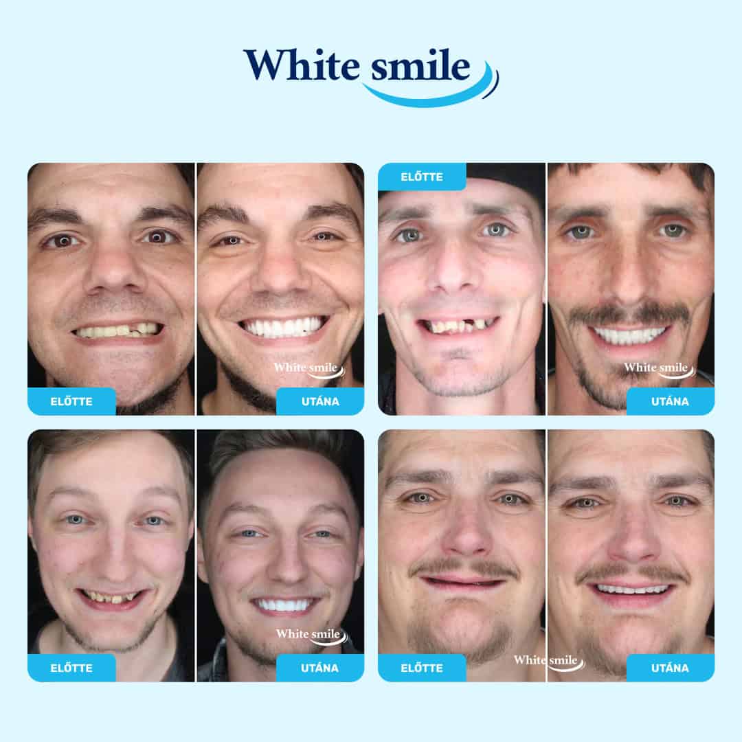 WHITESMILE™ – Állítható Kozmetikai Foghéj - Image 3