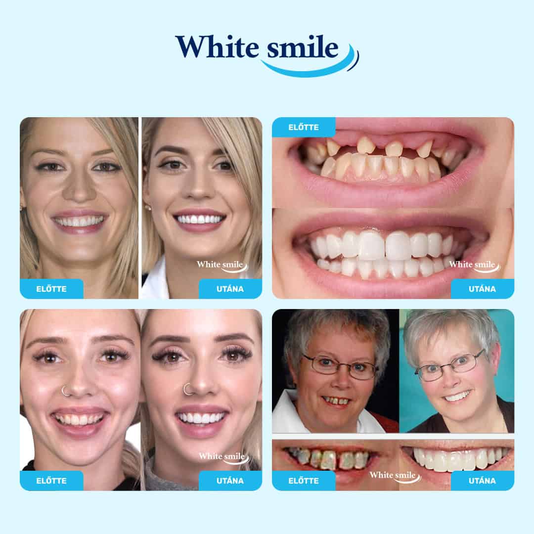 WHITESMILE™ – Állítható Kozmetikai Foghéj - Image 2