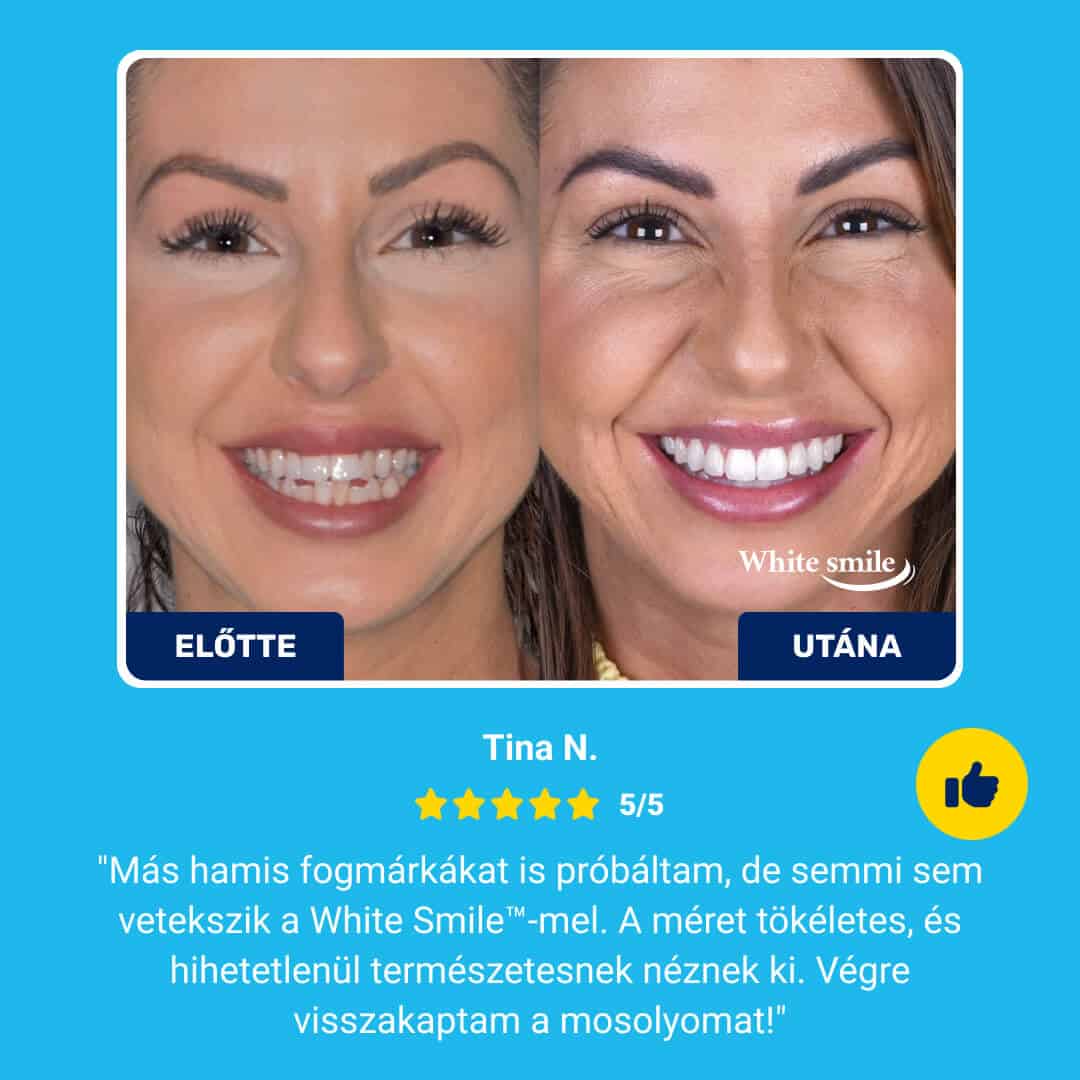 WHITESMILE™ – Állítható Kozmetikai Foghéj - Image 7